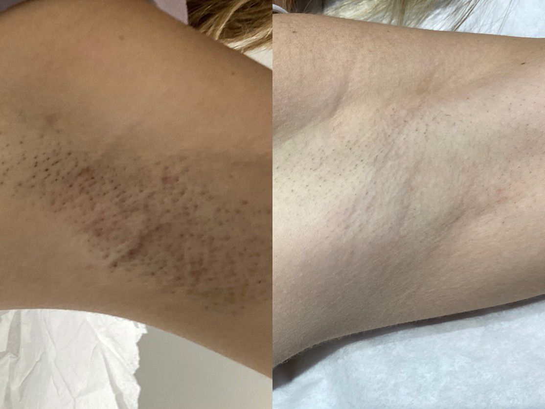 Laser Hair Removal before and after photo