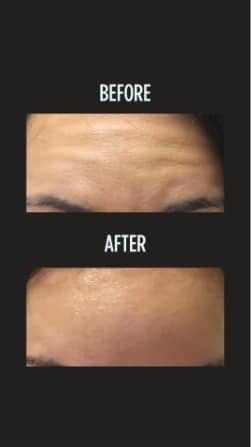 Botox Before and After Photo