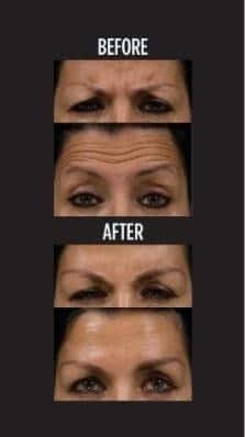 Botox / Xeomin before and after photo