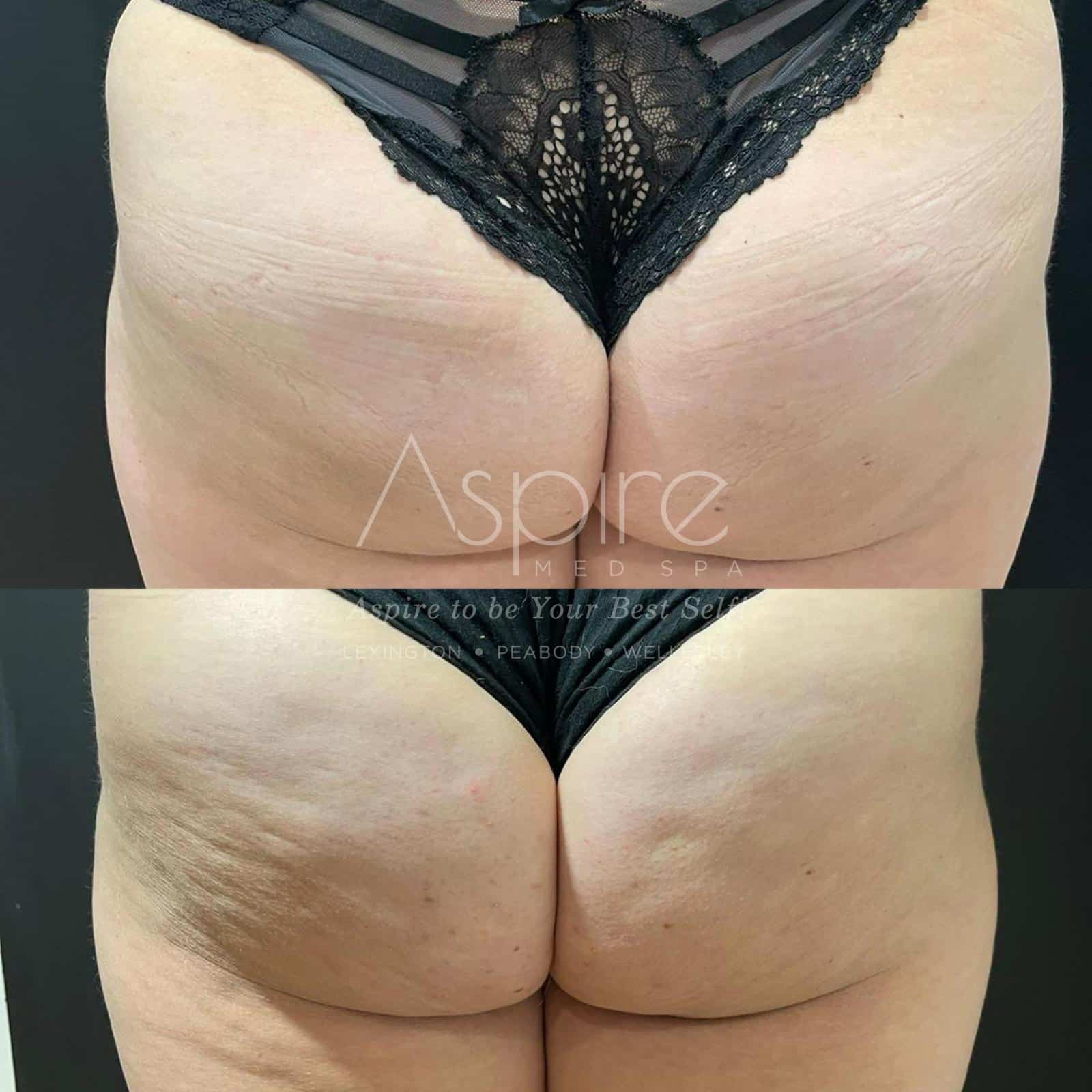 Body Contouring Before and After Photo