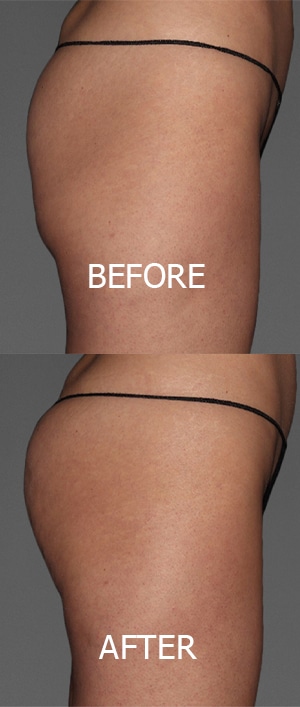 Brazilian Butt Lift before and after photo