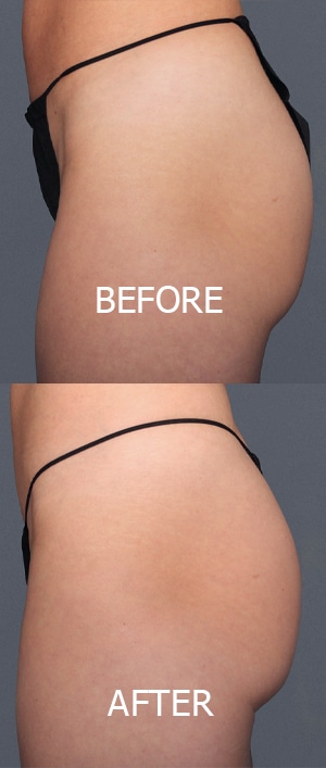 Non-Surgical Brazilian Butt Lift Before and After Photo