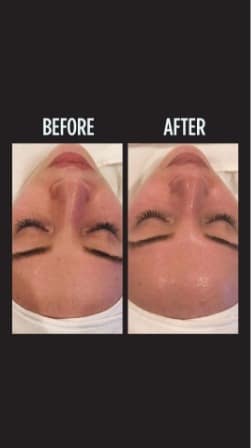 Hydrafacial MD Before and After Photo