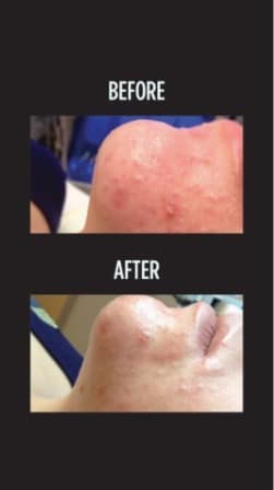 Hydrafacial MD Before and After Photo
