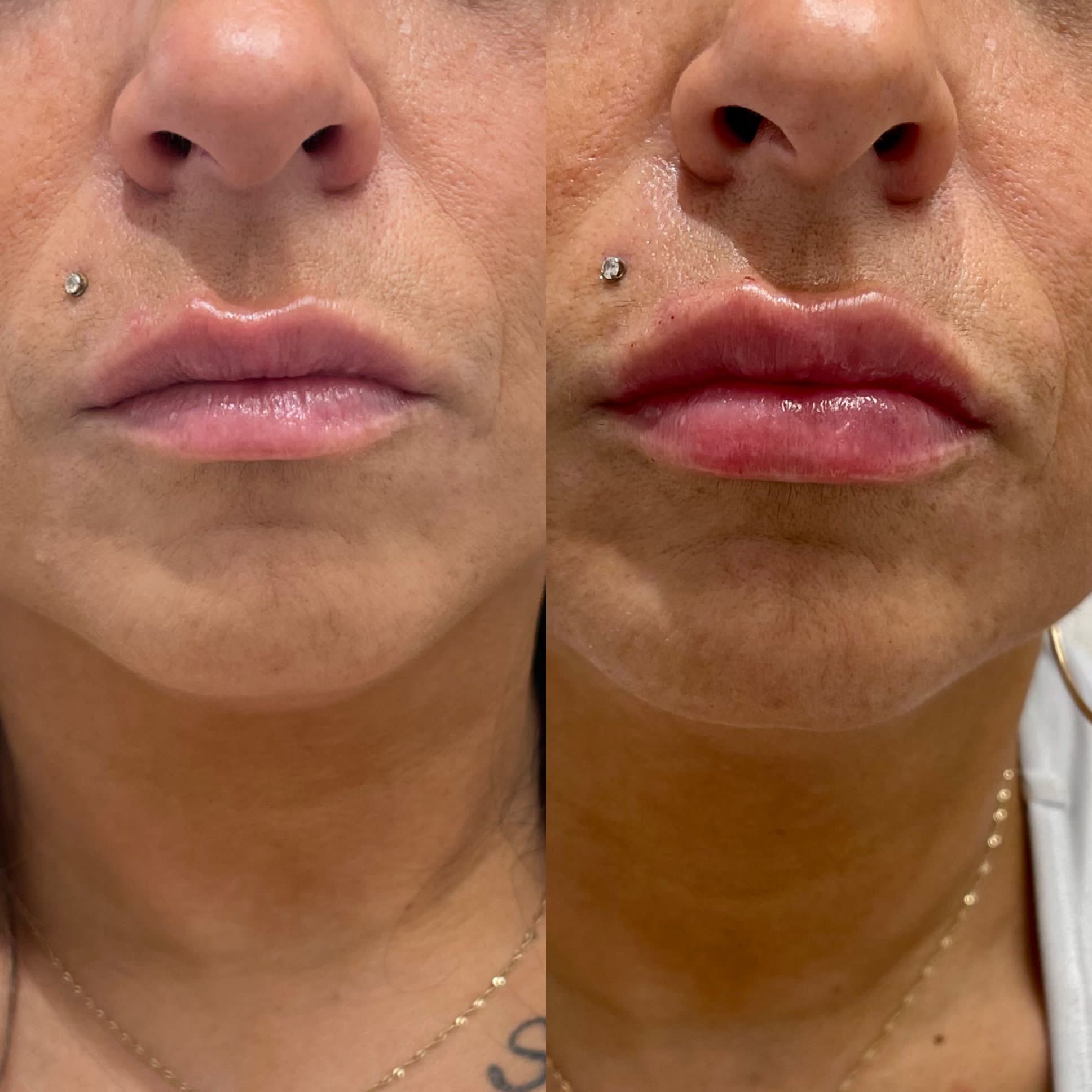 Fillers before and after photo