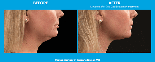 Laser Skin Resurfacing Before and After Photo