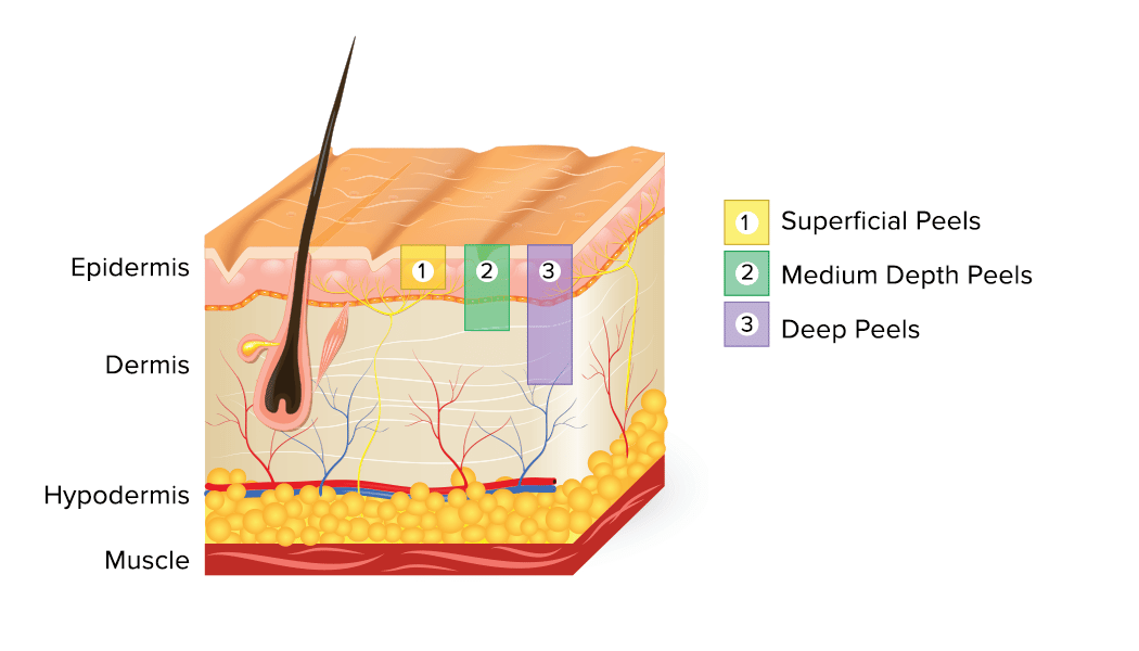 How a Chemical Peel works illustration